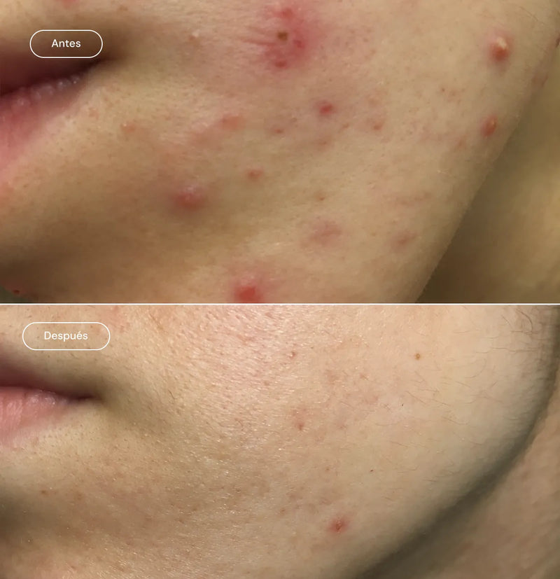 Sebum balance sérum