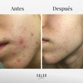 Pack Acne balance