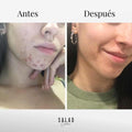 Pack Acne balance